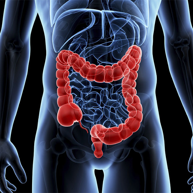 COLON CANCER